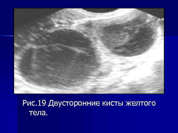 Рис. 19 Двусторонние кисты желтого тела. 