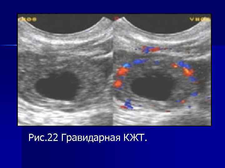 Рис. 22 Гравидарная КЖТ. 