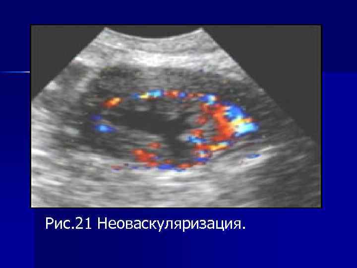 Рис. 21 Неоваскуляризация. 