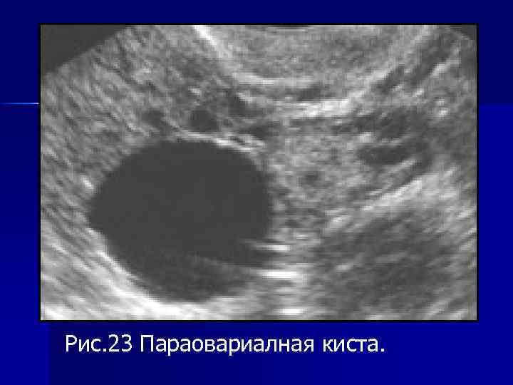 Киста яичника на узи. Параовариальная киста на УЗИ яичника. Параовариальные кисты яичников на УЗИ. Киста арахноидальная на яичнике это.