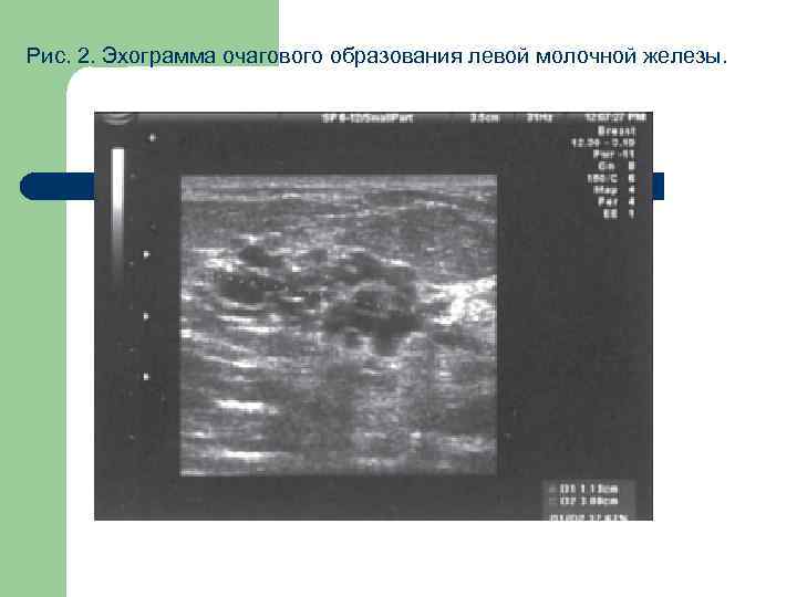 Рис. 2. Эхограмма очагового образования левой молочной железы. 