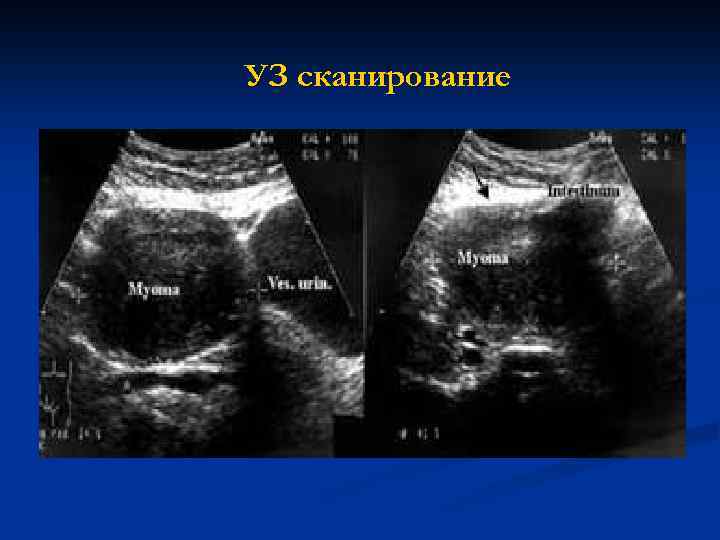 Как выглядит миома на узи фото
