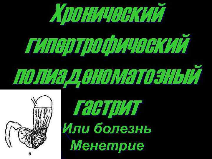 Хронический гипертрофический полиаденоматозный гастрит Или болезнь Менетрие 