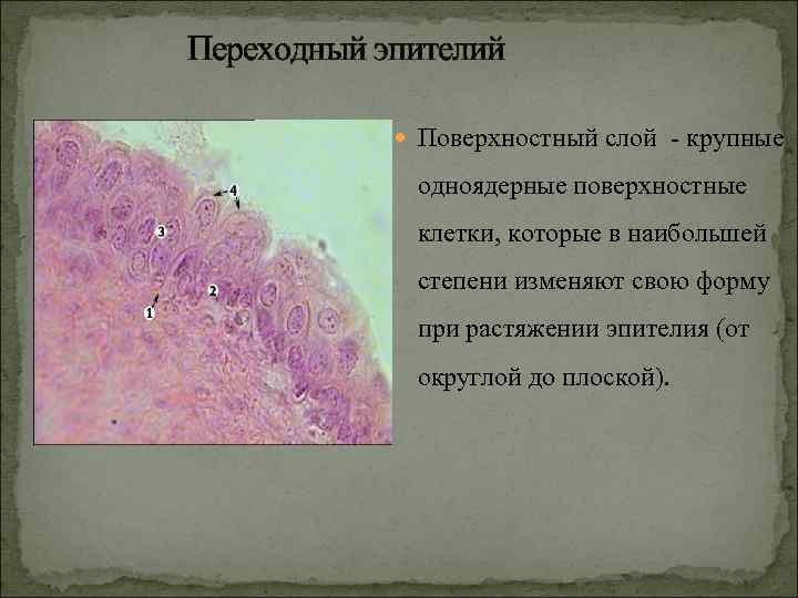 Переходный эпителий Поверхностный слой - крупные одноядерные поверхностные клетки, которые в наибольшей степени изменяют