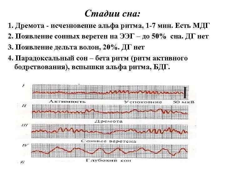 Стадии сна: 1. Дремота - исчезновение альфа ритма, 1 -7 мин. Есть МДГ 2.
