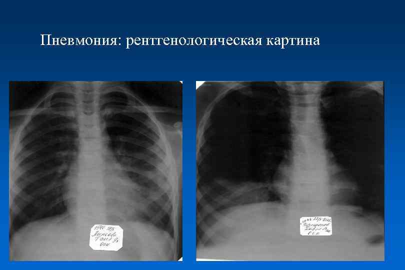 Хламидийная пневмония рентгенологическая картина