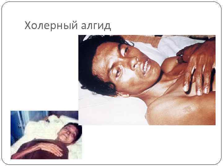 Холерный алгид 