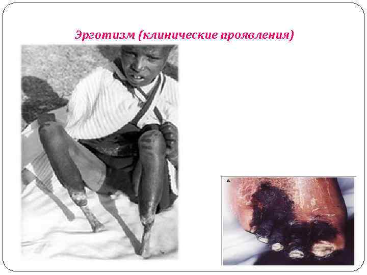 Эрготизм (клинические проявления) 