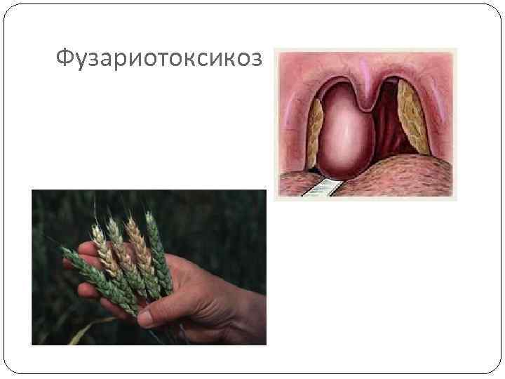 Фузариотоксикоз 