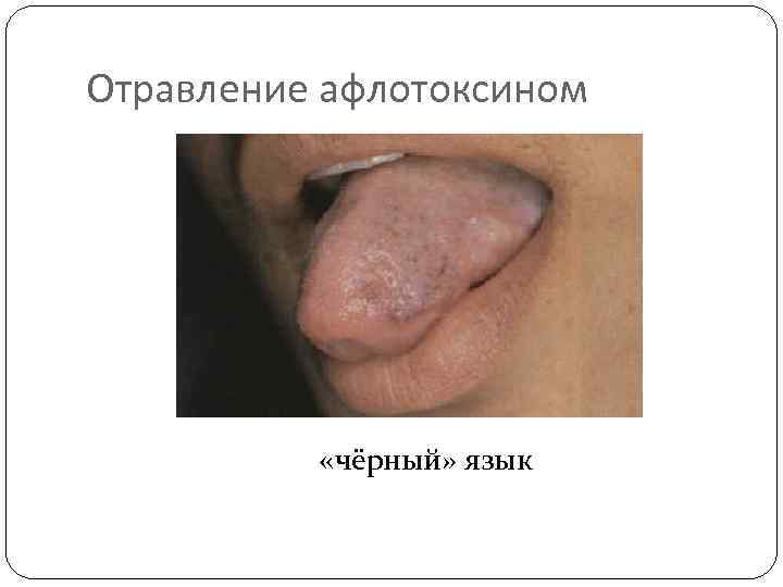 Отравление афлотоксином «чёрный» язык 