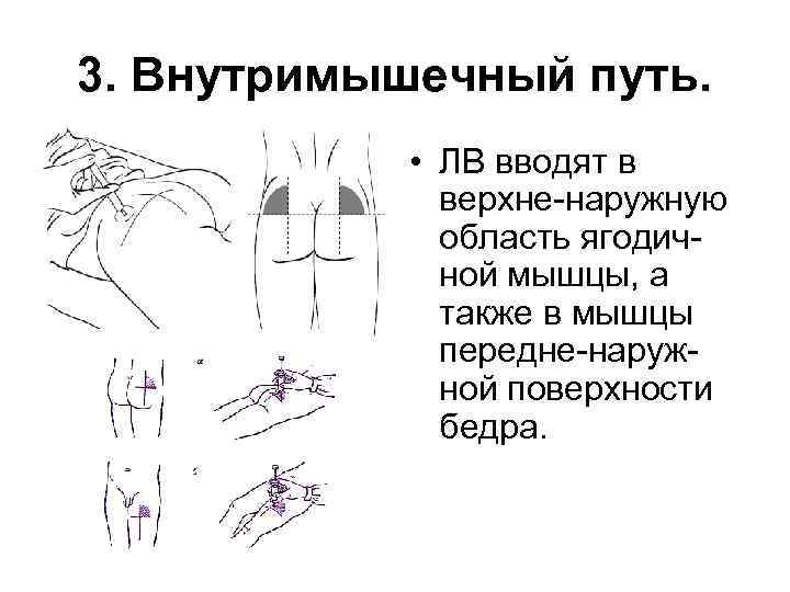3. Внутримышечный путь. • ЛВ вводят в верхне-наружную область ягодичной мышцы, а также в