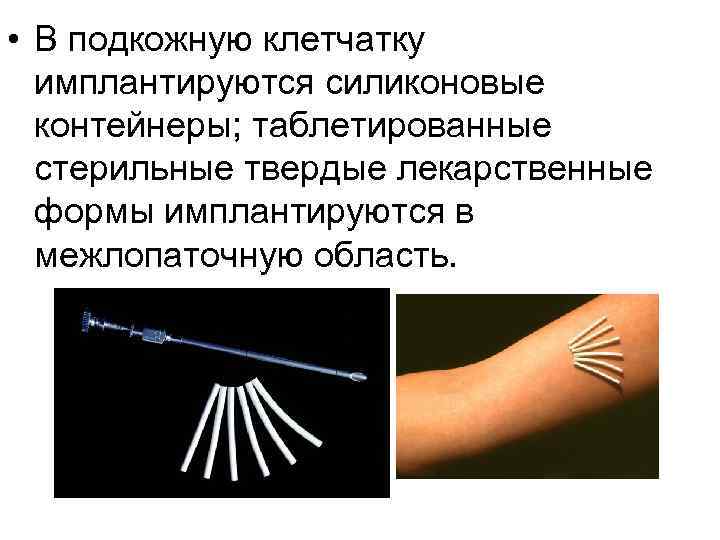  • В подкожную клетчатку имплантируются силиконовые контейнеры; таблетированные стерильные твердые лекарственные формы имплантируются