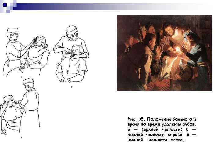 Рис. 35. Положение больного и врача во время удаления зубов. а — верхней челюсти;