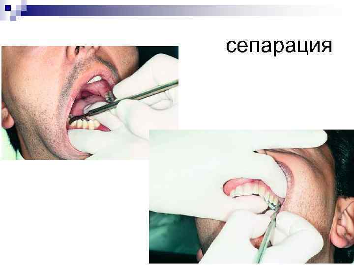сепарация 