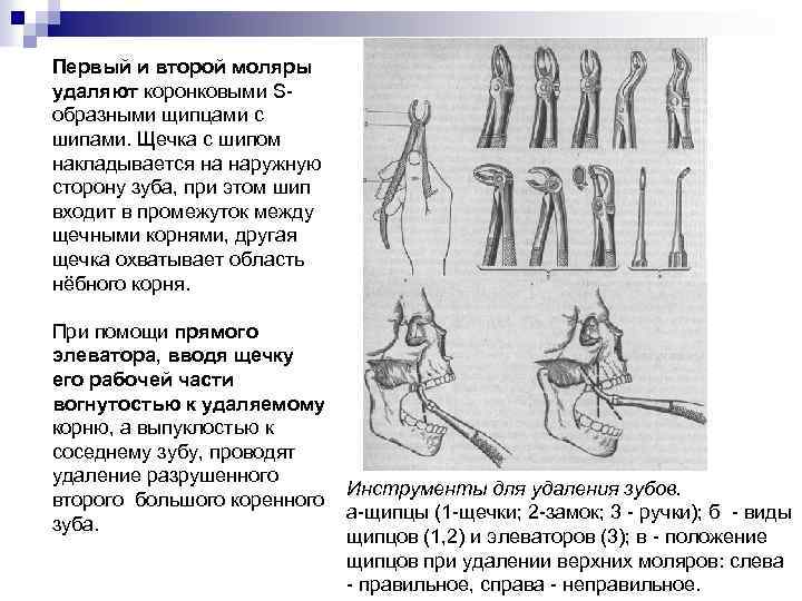 Первый и второй моляры удаляют коронковыми S образными щипцами с шипами. Щечка с шипом