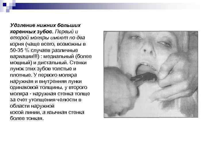 Удаление нижних больших коренных зубов. Первый и второй моляры имеют по два корня (чаще