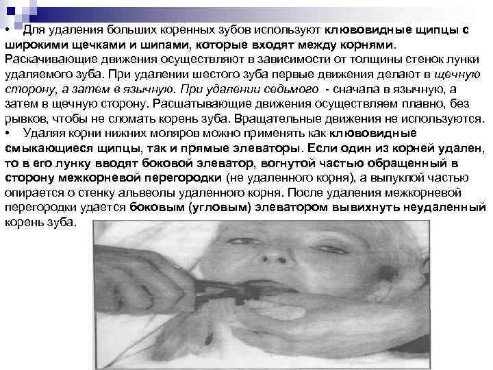  • Для удаления больших коренных зубов используют клювовидные щипцы с широкими щечками и