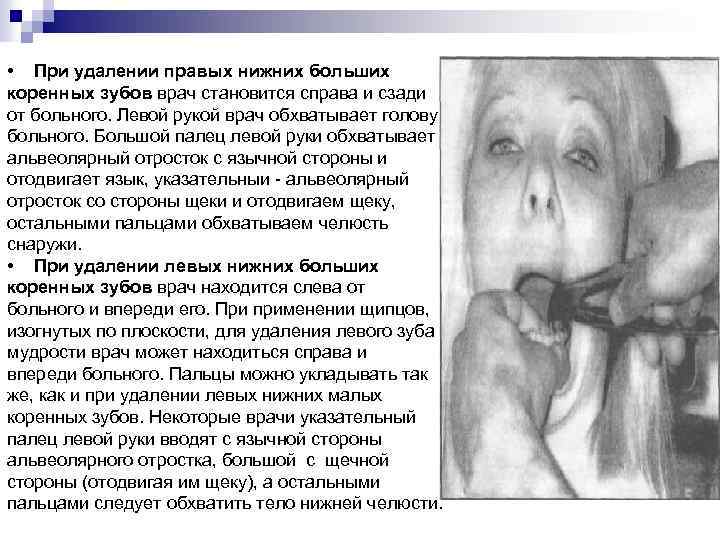  • При удалении правых нижних больших коренных зубов врач становится справа и сзади