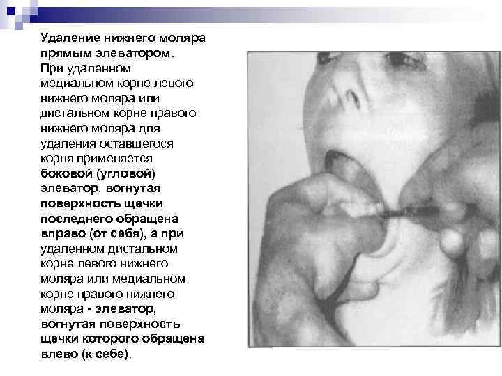 Удаление нижнего моляра прямым элеватором. При удаленном медиальном корне левого нижнего моляра или дистальном