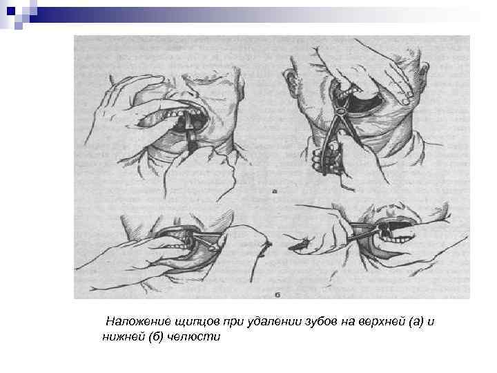 Наложение щипцов при удалении зубов на верхней (а) и нижней (б) челюсти 