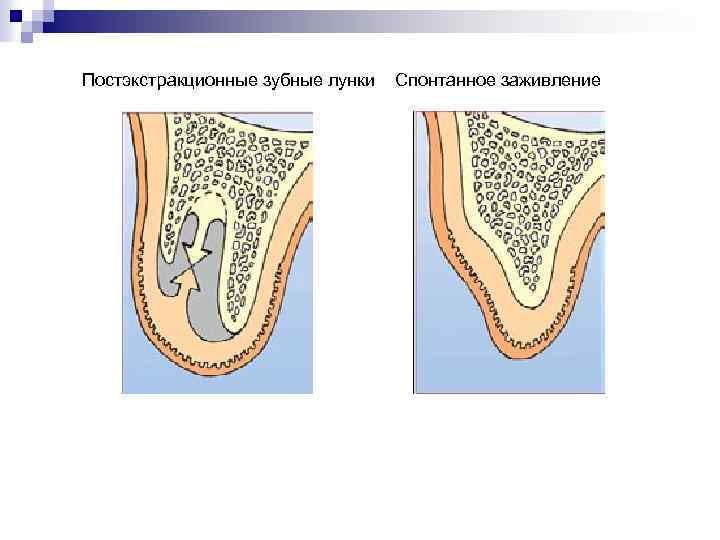 Постэкстракционные зубные лунки Спонтанное заживление НКР/НРТ/Мягкая ткань 