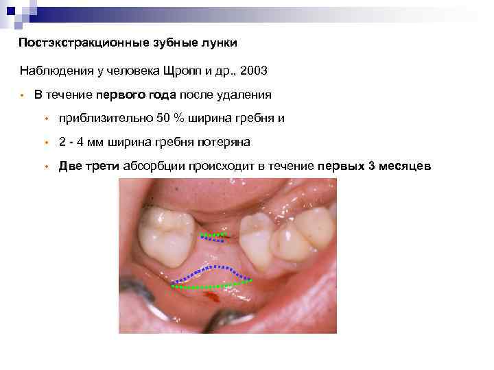 Постэкстракционные зубные лунки Наблюдения у человека Щропп и др. , 2003 • В течение