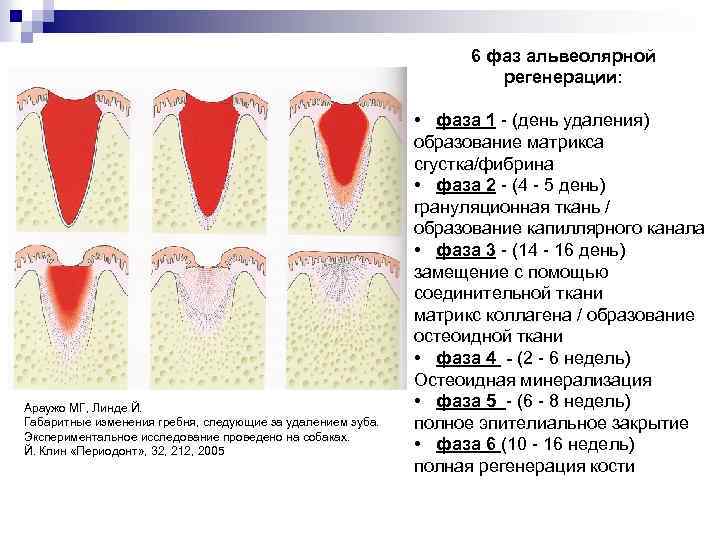 6 фаз альвеолярной регенерации: Постэкстракционные зубные лунки Араужо МГ, Линде Й. Габаритные изменения гребня,