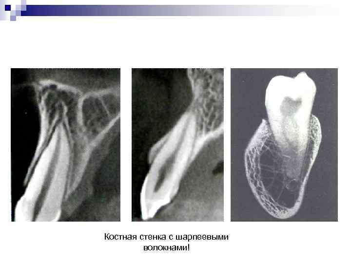 Костная стенка с шарпеевыми волокнами! 
