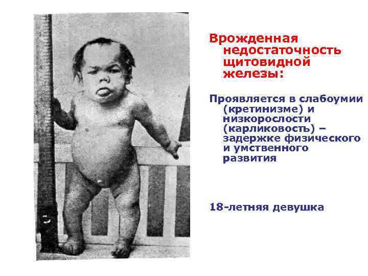 Врожденная недостаточность щитовидной железы: Проявляется в слабоумии (кретинизме) и низкорослости (карликовость) – задержке физического