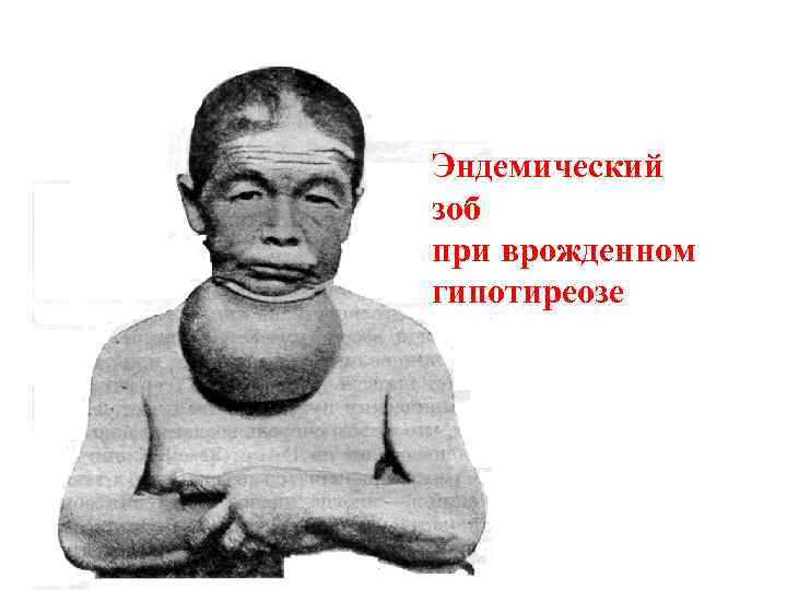 Эндемический зоб при врожденном гипотиреозе 