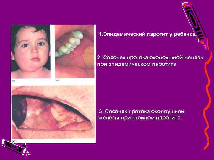 1. Эпидемический паротит у ребенка. 2. Сосочек протока околоушной железы при эпидемическом паротите. 3.