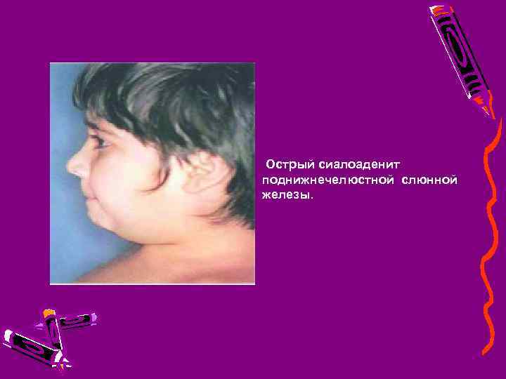 Острый сиалоаденит поднижнечелюстной слюнной железы. 