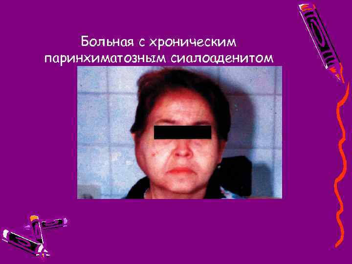 Больная с хроническим паринхиматозным сиалоаденитом 