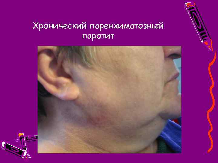 Хронический паренхиматозный паротит 