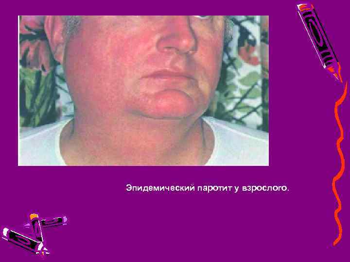 Эпидемический паротит у взрослого. 