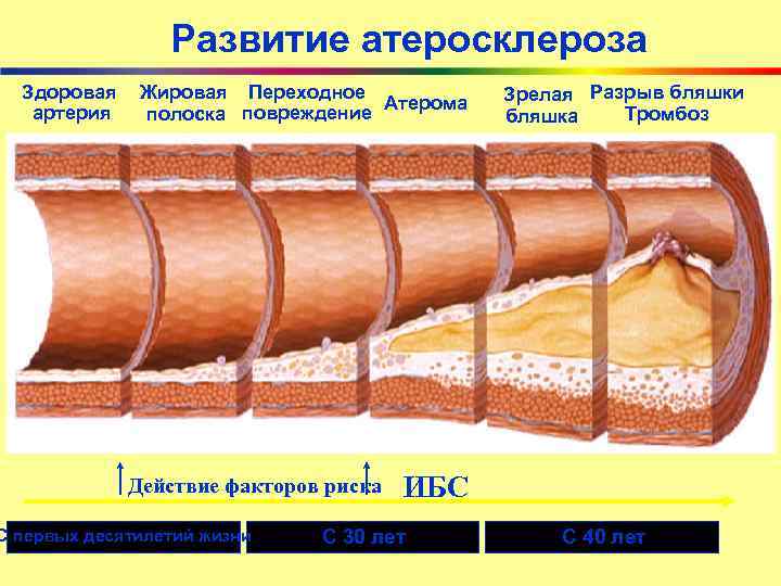 Развитие атеросклероза Здоровая артерия Жировая Переходное Атерома полоска повреждение Действие факторов риска С первых