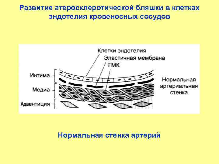 Развитие атеросклеротической бляшки в клетках эндотелия кровеносных сосудов Нормальная стенка артерий 