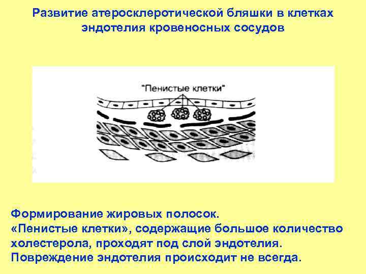 Развитие атеросклеротической бляшки в клетках эндотелия кровеносных сосудов Формирование жировых полосок. «Пенистые клетки» ,