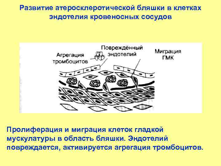 Развитие атеросклеротической бляшки в клетках эндотелия кровеносных сосудов Пролиферация и миграция клеток гладкой мускулатуры