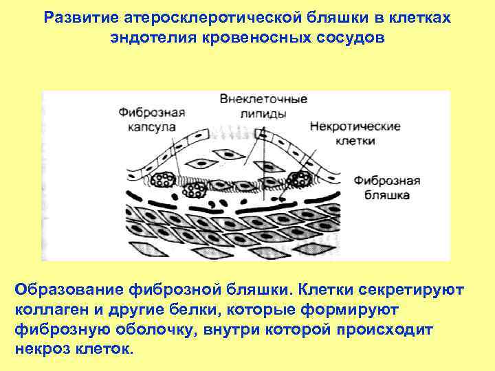 Развитие атеросклеротической бляшки в клетках эндотелия кровеносных сосудов Образование фиброзной бляшки. Клетки секретируют коллаген