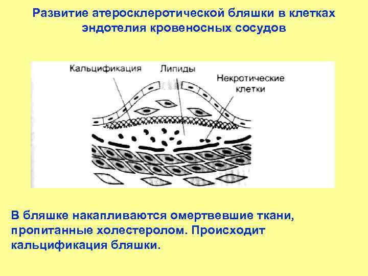 Развитие атеросклеротической бляшки в клетках эндотелия кровеносных сосудов В бляшке накапливаются омертвевшие ткани, пропитанные