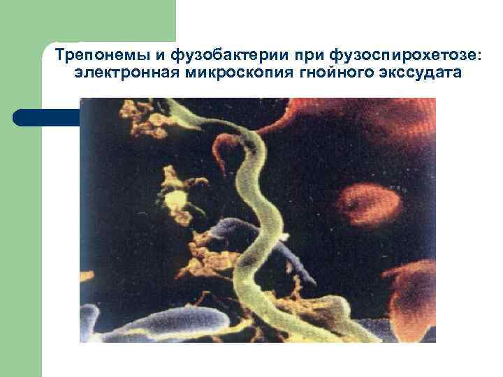 Трепонемы и фузобактерии при фузоспирохетозе: электронная микроскопия гнойного экссудата 