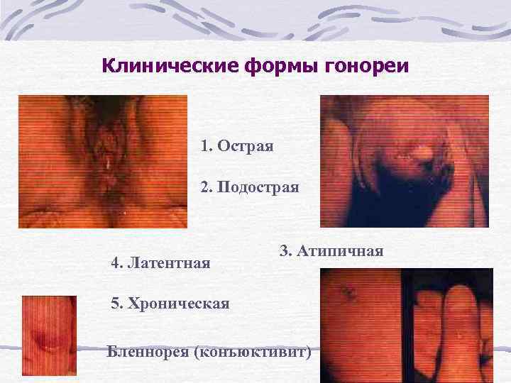 Клинические формы гонореи 1. Острая 2. Подострая 4. Латентная 3. Атипичная 5. Хроническая Бленнорея