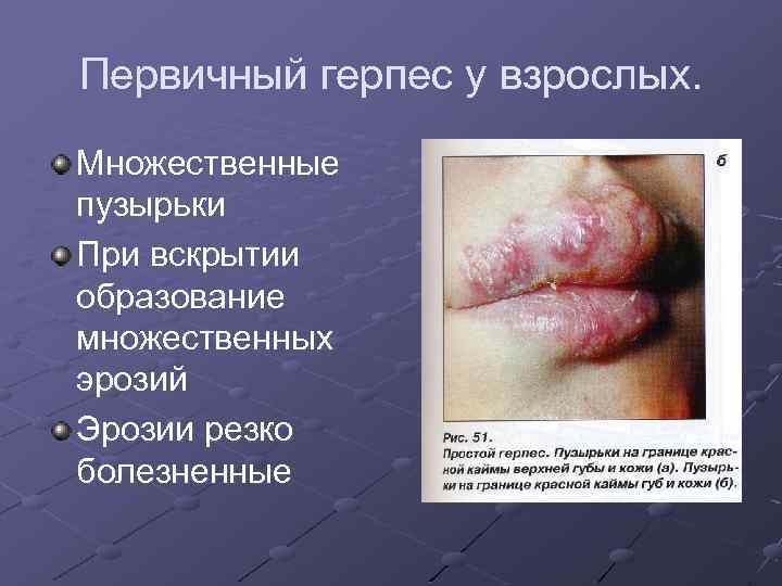 Первичный герпес у взрослых. Множественные пузырьки При вскрытии образование множественных эрозий Эрозии резко болезненные