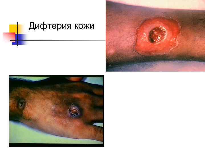 Дифтерия кожи 