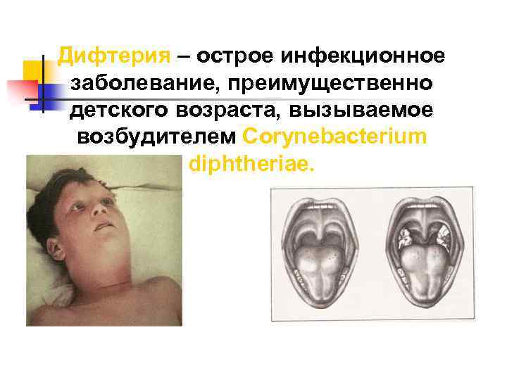 Дифтерия – острое инфекционное заболевание, преимущественно детского возраста, вызываемое возбудителем Corynebacterium diphtheriae. 