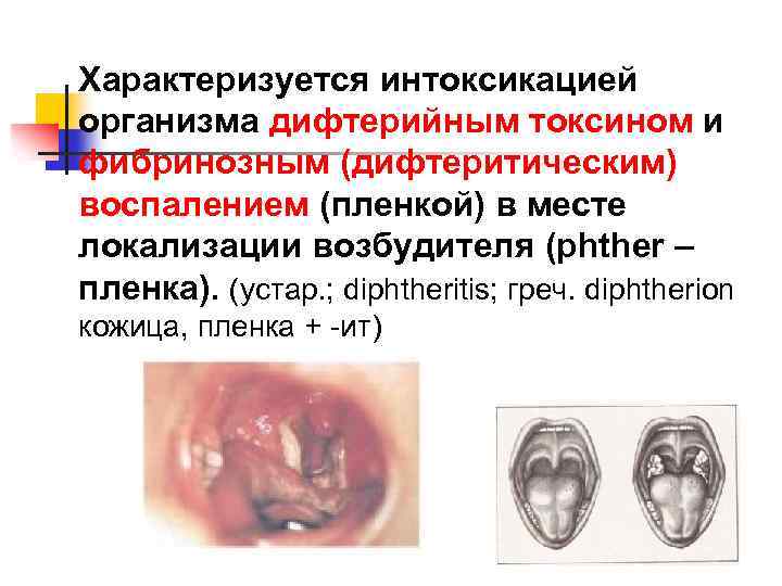 Характеризуется интоксикацией организма дифтерийным токсином и фибринозным (дифтеритическим) воспалением (пленкой) в месте локализации возбудителя