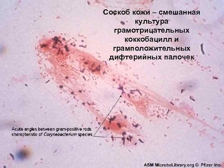 Соскоб кожи – смешанная культура грамотрицательных коккобацилл и грамположительных дифтерийных палочек 