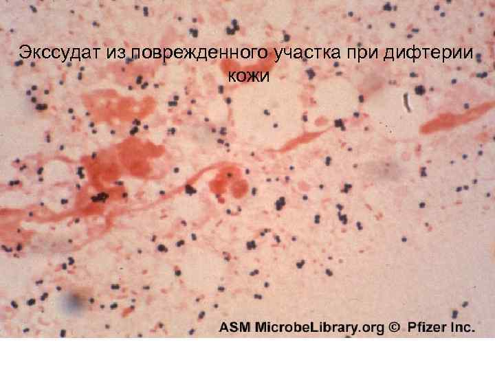 Экссудат из поврежденного участка при дифтерии кожи 