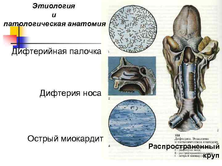 Этиология и патологическая анатомия Дифтерийная палочка Дифтерия носа Острый миокардит Распространенный круп 